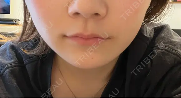 その他（鼻） / ボトックス（あご） / ボトックス（口角） / ボトックス（眉間） / ボトックス（人中） TCB東京中央美容外科 岡山院 AFTER メイン用