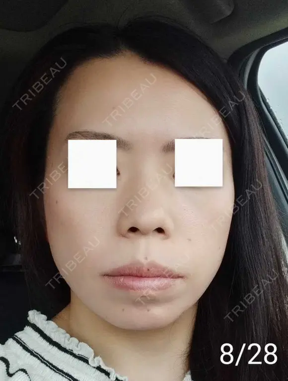 エレクトロポレーション / 毛穴洗浄（ハイドラフェイシャルなど） / 光治療（フォトフェイシャルなど） Leap beauty clinic DAY 10 メイン用