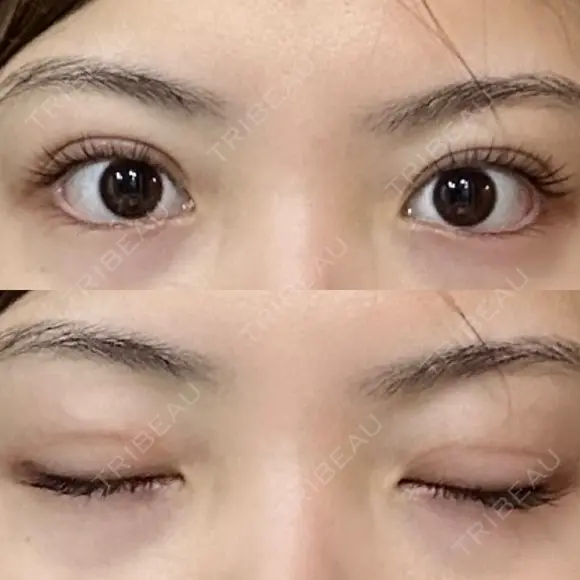 二重埋没 R.O.clinic DAY 10 メイン用