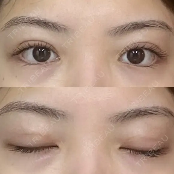 二重埋没 R.O.clinic DAY 14 メイン用