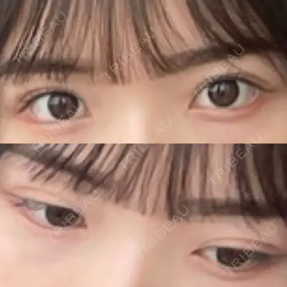 二重埋没 R.O.clinic DAY 37 メイン用