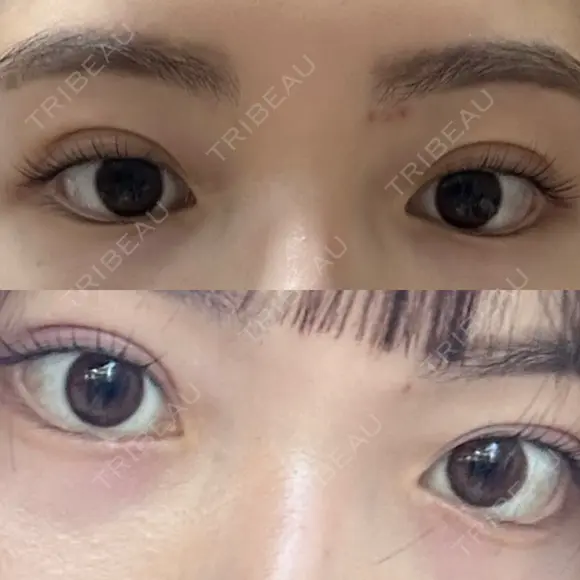 二重埋没 R.O.clinic DAY 61 メイン用