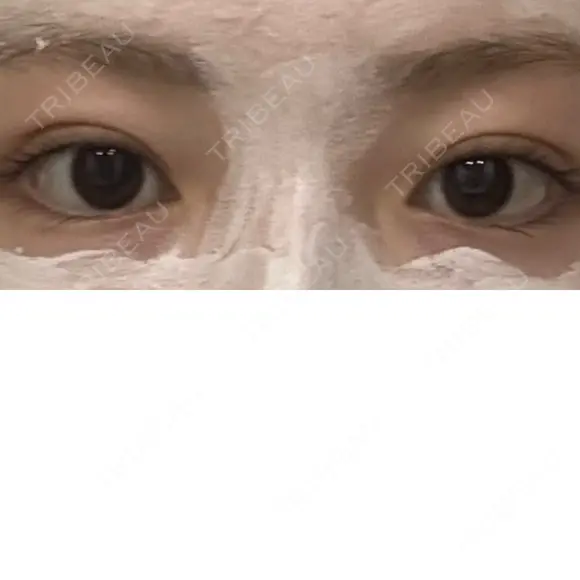 二重埋没 R.O.clinic DAY 111 メイン用