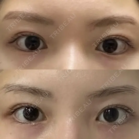 二重埋没 R.O.clinic DAY 127 メイン用