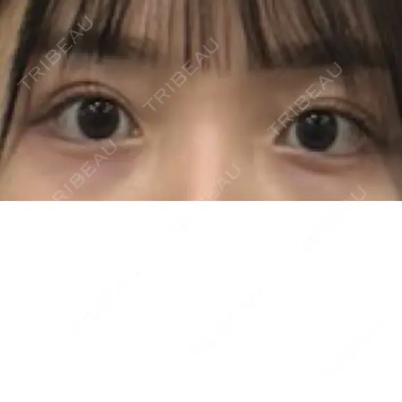 二重埋没 R.O.clinic DAY 148 メイン用