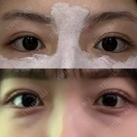 二重埋没 R.O.clinic AFTER メイン用