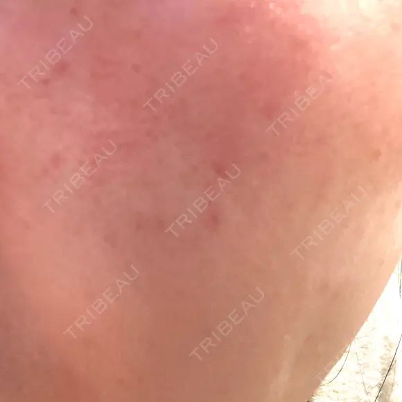 リジュラン 小木曽クリニック DAY 1 メイン用