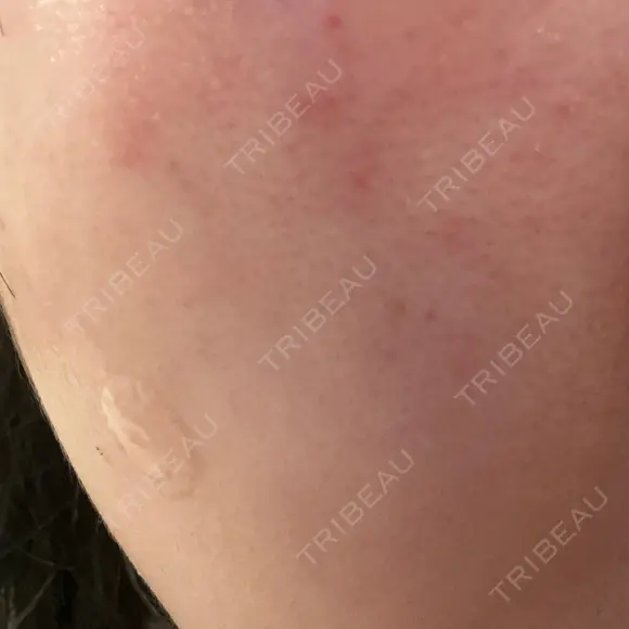 リジュラン 小木曽クリニック DAY 1 メイン用