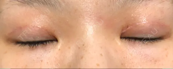 眼瞼下垂（切開） 東京皮膚科・形成外科 (銀座いけだクリニック) DAY 30 メイン用