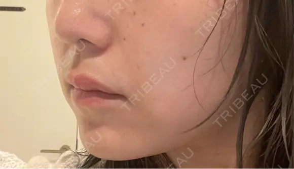 ボトックス（あご） / ボトックス（エラ・小顔） / 脂肪溶解注射（顔） / ボトックス（人中） Kinshicho Beauty Clinic （錦糸町ビューティークリニック） DAY 21 メイン用