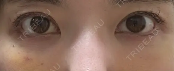 クマ治療 / 下まぶたたるみ取り / 下まぶたの脂肪取り / 脂肪注入（目の下） / ボトックス（あご） / ボトックス（眉間） お茶の水美容形成クリニック DAY 7 メイン用