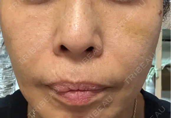 ショッピングリフト Natural Skin Clinic 笹塚院 DAY 14 メイン用