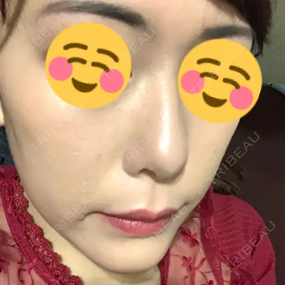 骨切り（あご） / 脂肪吸引（顔） / セットバック / ルフォー+ssro（両あご) リッツ美容外科 東京院 AFTER メイン用