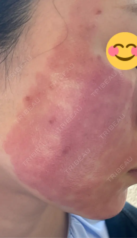 ルビーレーザー AZ BEAUTY CLINIC DAY 0 メイン用