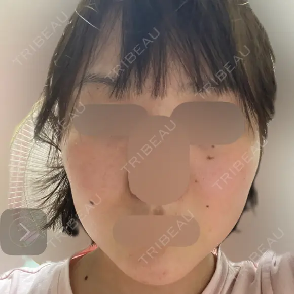 RF（高周波）たるみ治療 ルラ美容クリニック 福岡本院 DAY 8 メイン用