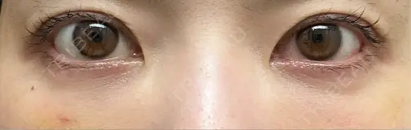 クマ治療 / 下まぶたたるみ取り / 下まぶたの脂肪取り / 脂肪注入（目の下） / ボトックス（あご） / ボトックス（眉間） お茶の水美容形成クリニック DAY 9 メイン用