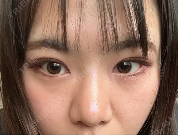 二重埋没 / 隆鼻術 / 鼻尖形成（切開） / 小鼻縮小（切開） / 軟骨移植 R Beauty CLINIC 名古屋院 AFTER メイン用