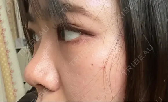 二重埋没 / 隆鼻術 / 鼻尖形成（切開） / 小鼻縮小（切開） / 軟骨移植 R Beauty CLINIC 名古屋院 DAY 238 メイン用