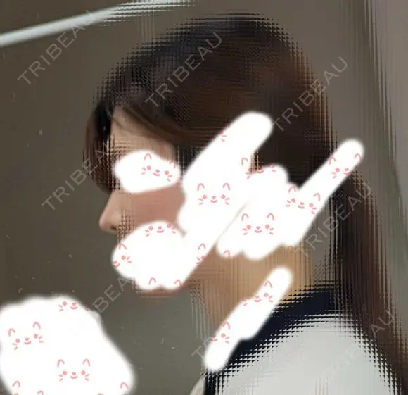 ヒアルロン酸注入（鼻） TCB東京中央美容外科 青森院 DAY 24 メイン用