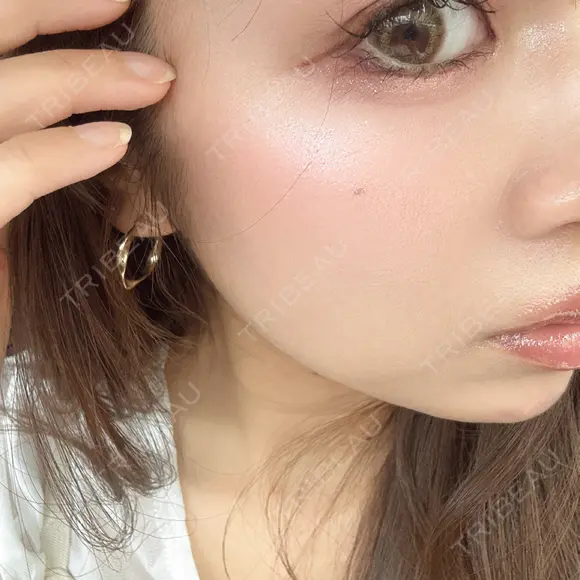 ヒアルロン酸注入（涙袋） アネシス美容クリニック AFTER メイン用