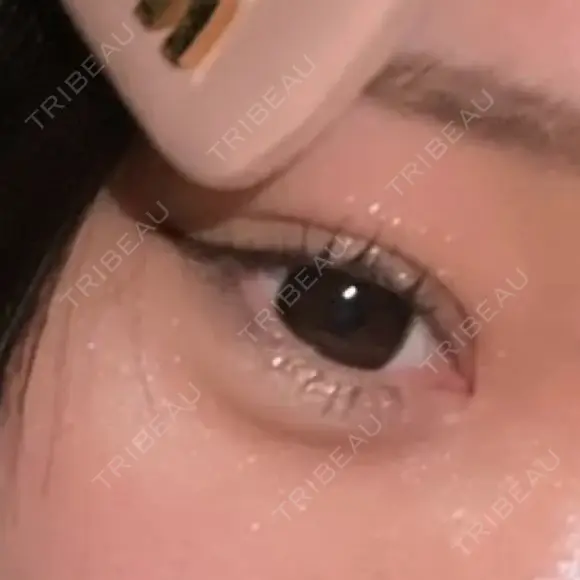 二重切開 / 眼瞼下垂（切開） EMMO FACE CLINIC 東京三田院 AFTER メイン用