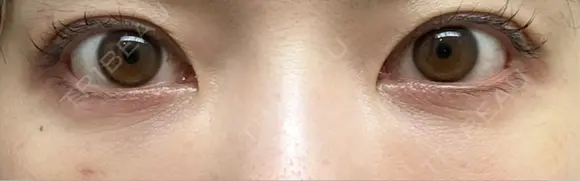 クマ治療 / 下まぶたたるみ取り / 下まぶたの脂肪取り / 脂肪注入（目の下） / ボトックス（あご） / ボトックス（眉間） お茶の水美容形成クリニック DAY 9 メイン用