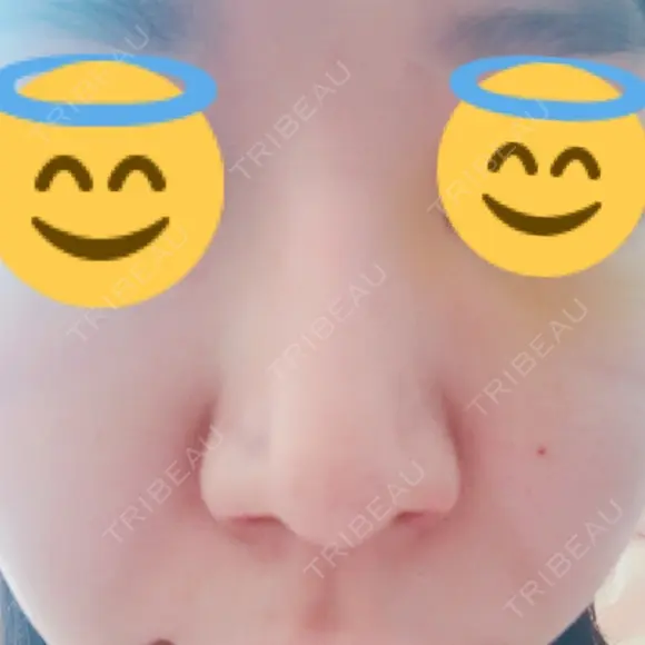 鼻孔縁挙上 / その他（鼻） シエルクリニック DAY 6 メイン用