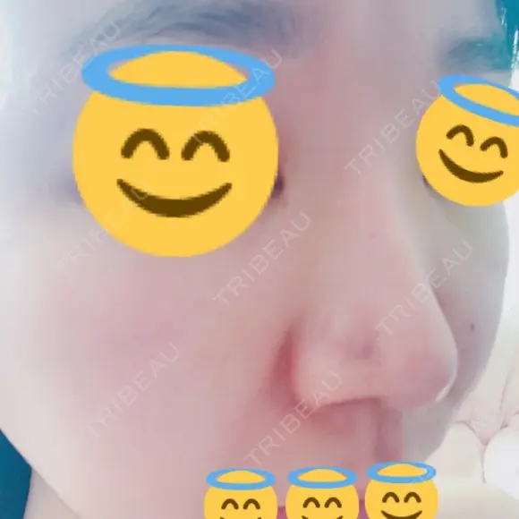 鼻孔縁挙上 / その他（鼻） シエルクリニック DAY 6 メイン用