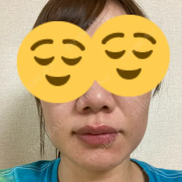 小鼻縮小（非切開） / ボトックス（口角） 形成外科と美容外科のクリニック池袋 AFTER メイン用