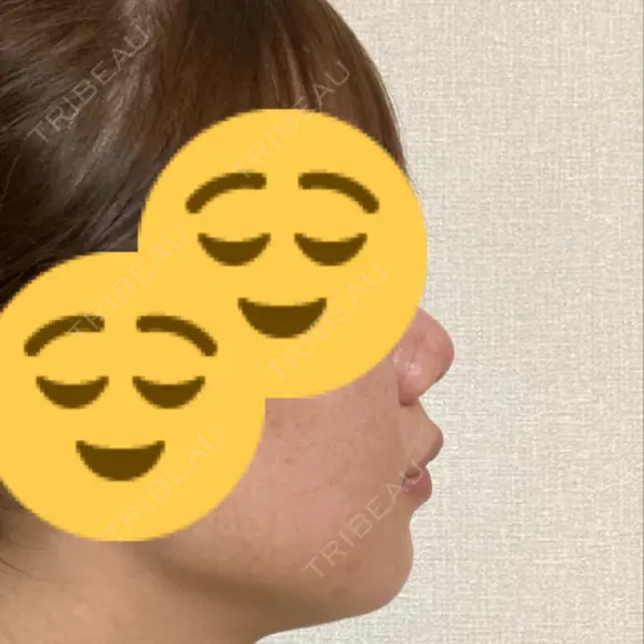 小鼻縮小（非切開） / ボトックス（口角） 形成外科と美容外科のクリニック池袋 DAY 0 メイン用