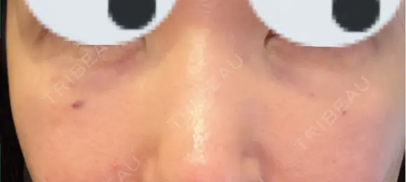 ヒアルロン酸溶解 小木曽クリニック DAY 0 メイン用