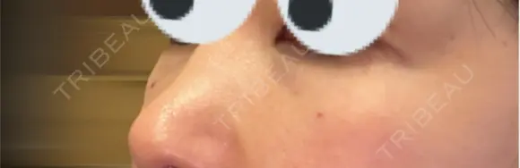 ヒアルロン酸溶解 小木曽クリニック DAY 0 メイン用