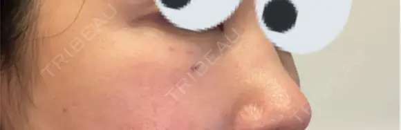 ヒアルロン酸溶解 小木曽クリニック DAY 0 メイン用