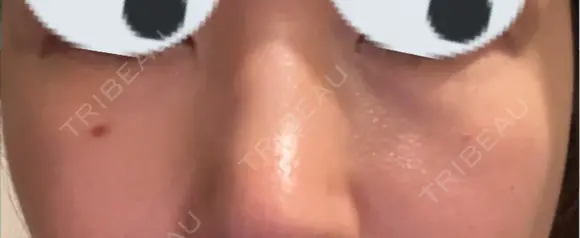 ヒアルロン酸溶解 小木曽クリニック AFTER メイン用