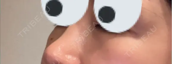 ヒアルロン酸溶解 小木曽クリニック DAY 7 メイン用