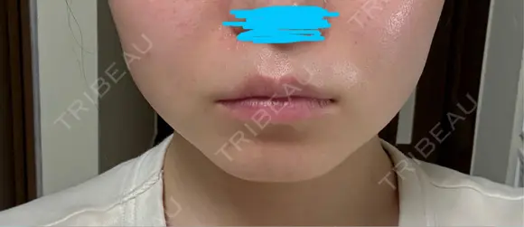 RF（高周波）たるみ治療 CIEL SKIN CLINIC（シエルスキンクリニック） DAY 56 メイン用