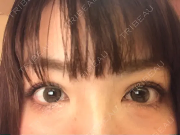 二重埋没 城本クリニック 大阪院 DAY 42 メイン用