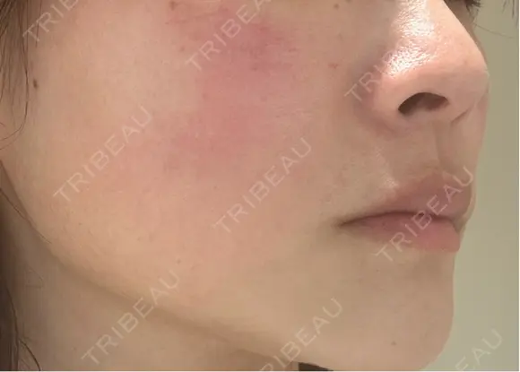 美肌レーザー / 美白レーザー / YAGレーザー / レーザーフェイシャル / 赤み除去レーザー AI Beauty Clinic （エーアイ美容クリニック） DAY 0 メイン用