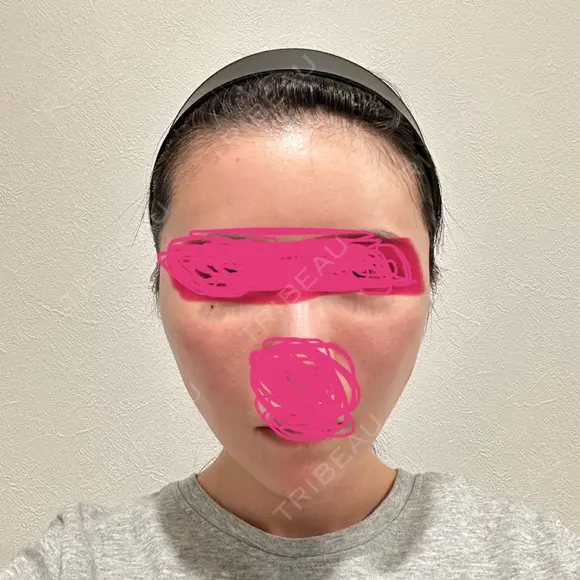 糸リフト / ヒアルロン酸注入（頬） EMMO FACE CLINIC 東京三田院 DAY 0 メイン用