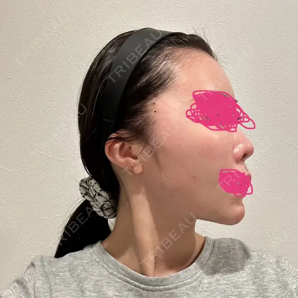 糸リフト / ヒアルロン酸注入（頬） EMMO FACE CLINIC 東京三田院 DAY 0 メイン用