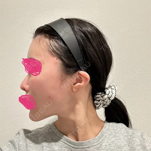 糸リフト / ヒアルロン酸注入（頬） EMMO FACE CLINIC 東京三田院 DAY 0 メイン用