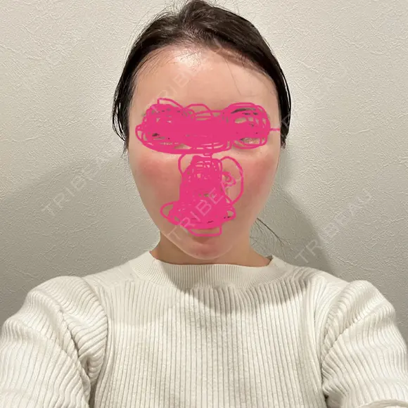 糸リフト / ヒアルロン酸注入（頬） EMMO FACE CLINIC 東京三田院 AFTER メイン用