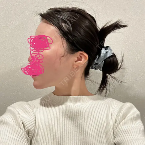 糸リフト / ヒアルロン酸注入（頬） EMMO FACE CLINIC 東京三田院 DAY 31 メイン用