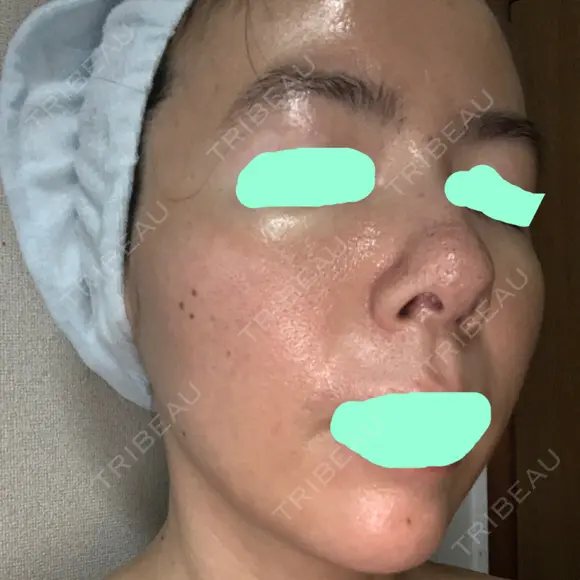 その他（肌） / ダーマペン スキンリファインクリニック銀座 DAY 7 メイン用