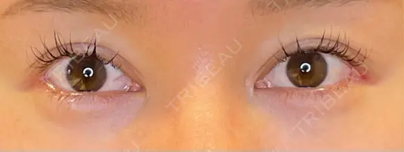 目尻切開 / タレ目形成・グラマラスライン（埋没） / ヒアルロン酸注入（涙袋） / ボトックス（口角） LOUIS CLINIC 二子玉川院【ルイクリニック】 DAY 8 メイン用