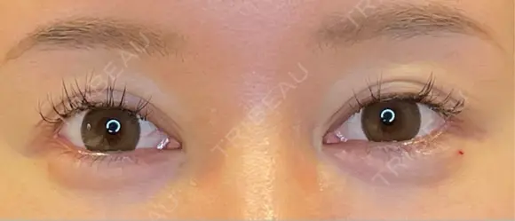 目尻切開 / タレ目形成・グラマラスライン（埋没） / ヒアルロン酸注入（涙袋） / ボトックス（口角） LOUIS CLINIC 二子玉川院【ルイクリニック】 DAY 15 メイン用