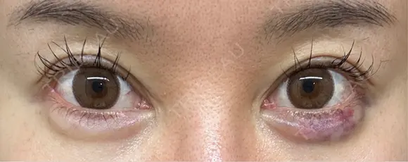 目尻切開 / タレ目形成・グラマラスライン（埋没） / ヒアルロン酸注入（涙袋） / ボトックス（口角） LOUIS CLINIC 二子玉川院【ルイクリニック】 DAY 15 メイン用