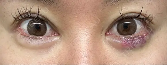 目尻切開 / タレ目形成・グラマラスライン（埋没） / ヒアルロン酸注入（涙袋） / ボトックス（口角） LOUIS CLINIC 二子玉川院【ルイクリニック】 DAY 16 メイン用