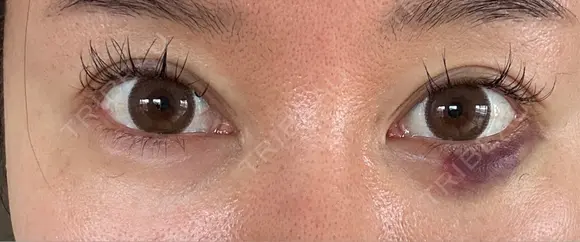 目尻切開 / タレ目形成・グラマラスライン（埋没） / ヒアルロン酸注入（涙袋） / ボトックス（口角） LOUIS CLINIC 二子玉川院【ルイクリニック】 DAY 17 メイン用