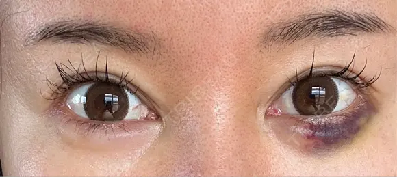 目尻切開 / タレ目形成・グラマラスライン（埋没） / ヒアルロン酸注入（涙袋） / ボトックス（口角） LOUIS CLINIC 二子玉川院【ルイクリニック】 DAY 18 メイン用